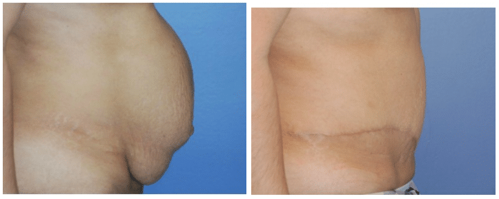 Tummy Tuck Before and After Tummy Tuck Before and After