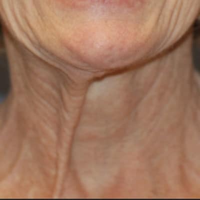 Before Image: Necklift - front