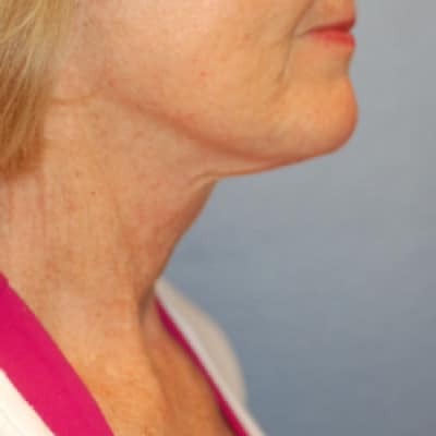 After Image: Necklift - right-side