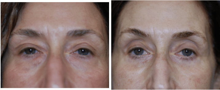 Blepharoplasty in Boston, MA