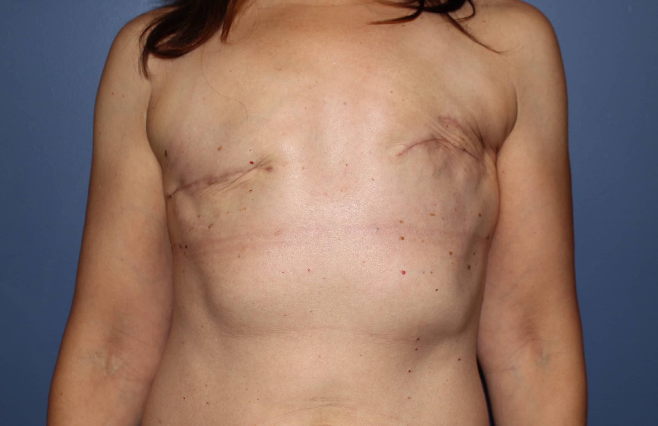 Going Flat After Mastectomy in Boston, MA