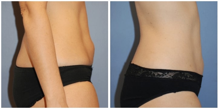 Liposuction Before & After