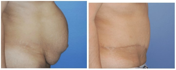 Tummy Tuck Before and After