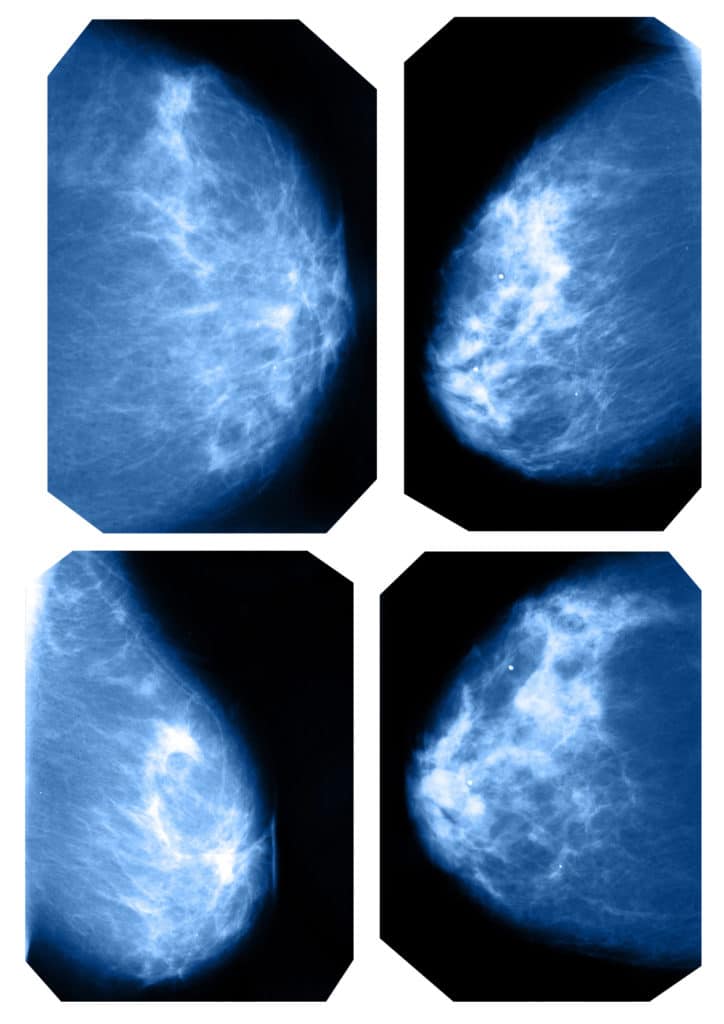 mammography images