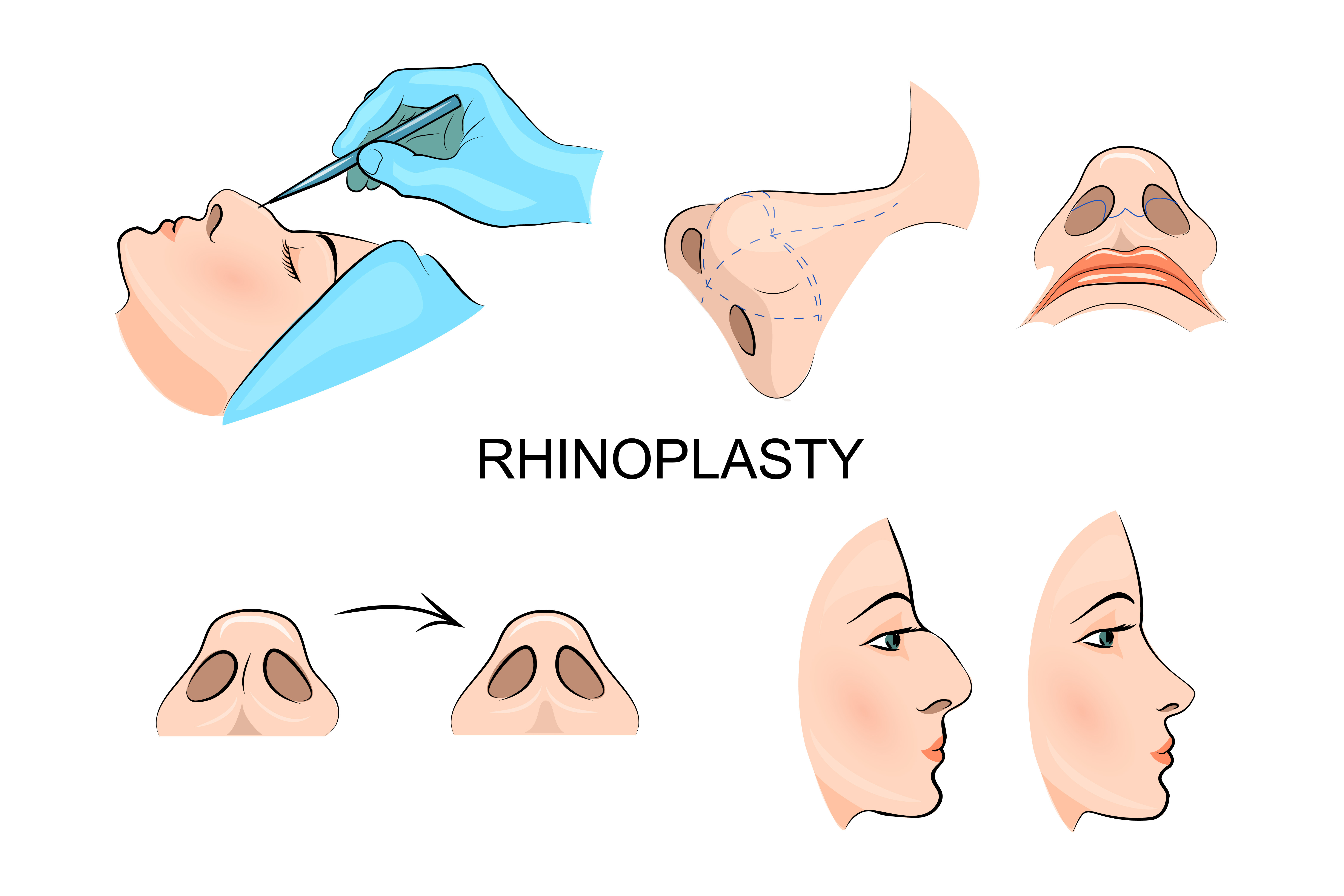 functional rhinoplasty Boston MA