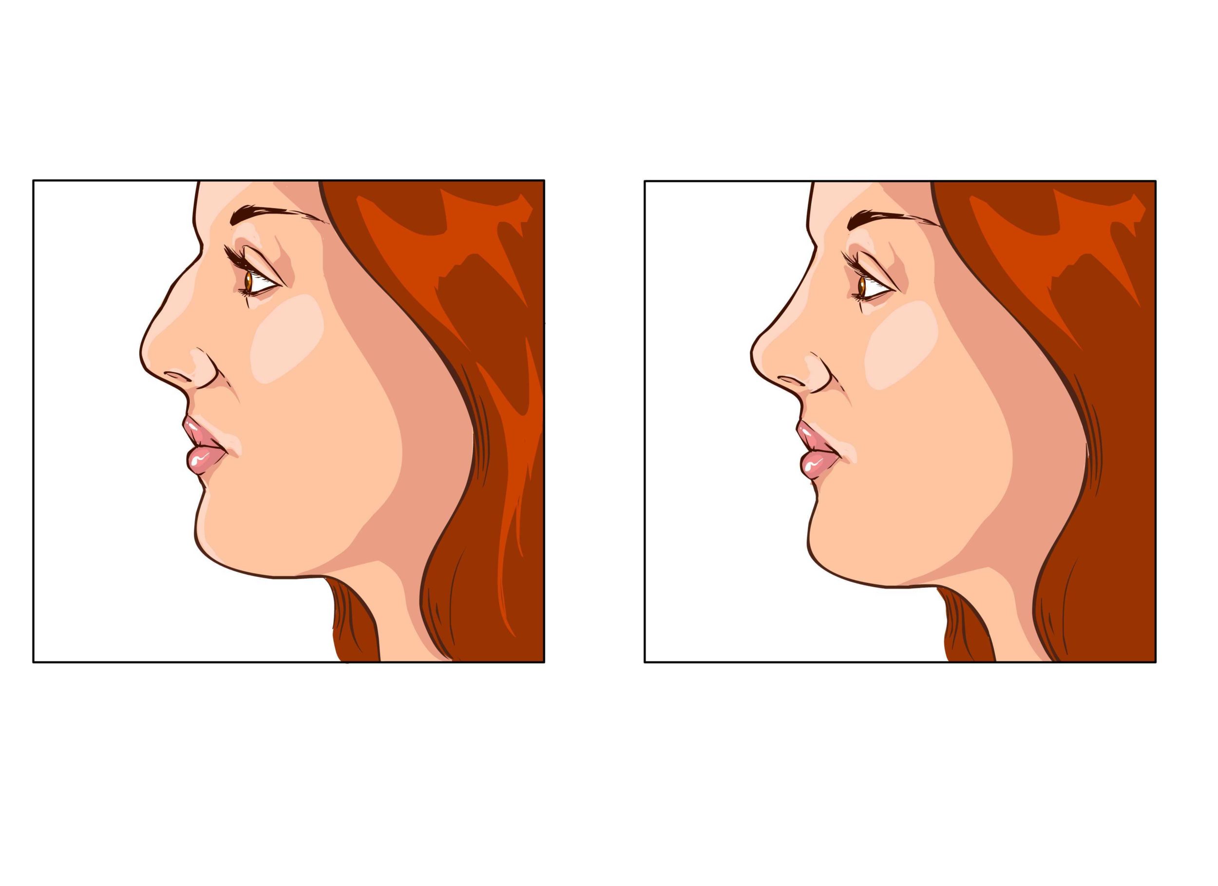 reduction rhinoplasty Boston MA
