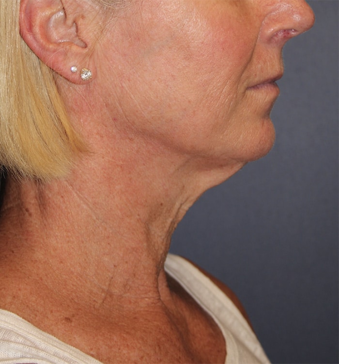 Before Image: Necklift - right-side