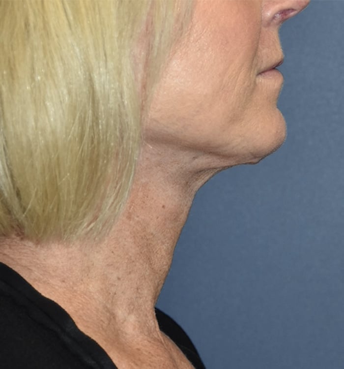 After Image: Necklift - right-side