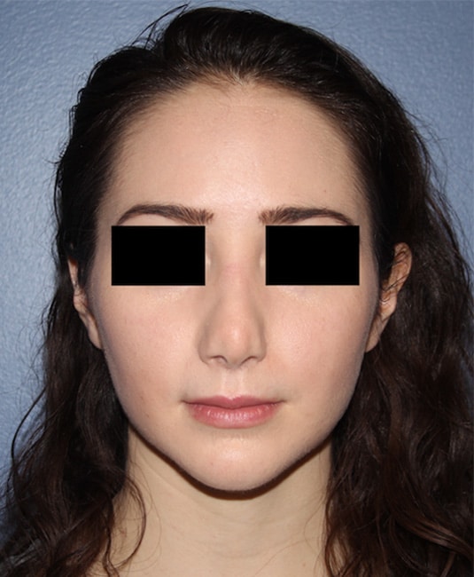 Before Image: Rhinoplasty - front