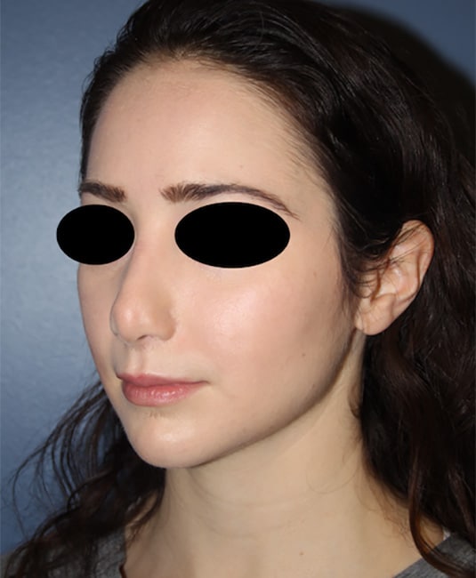 Before Image: Rhinoplasty - left-front-oblique
