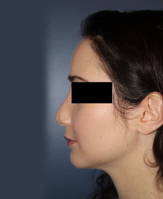Before Image: Rhinoplasty - left-side