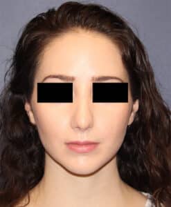 Rhinoplasty