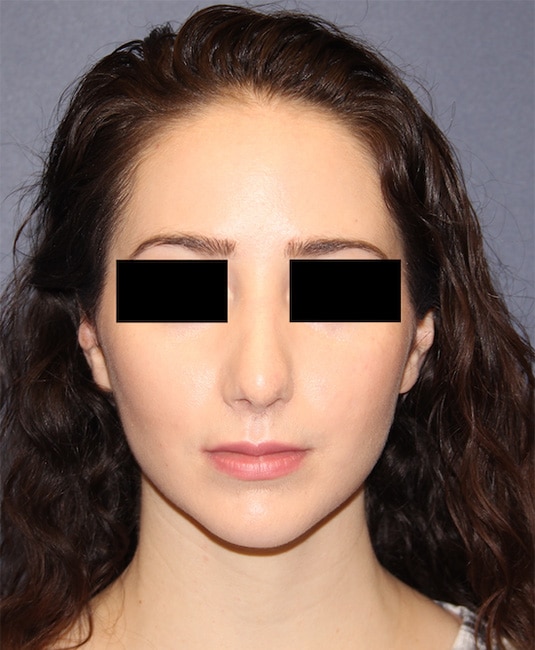 After Image: Rhinoplasty - front