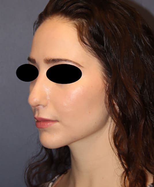 After Image: Rhinoplasty - left-front-oblique