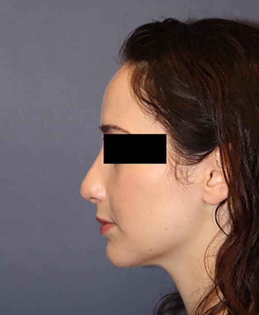After Image: Rhinoplasty - left-side