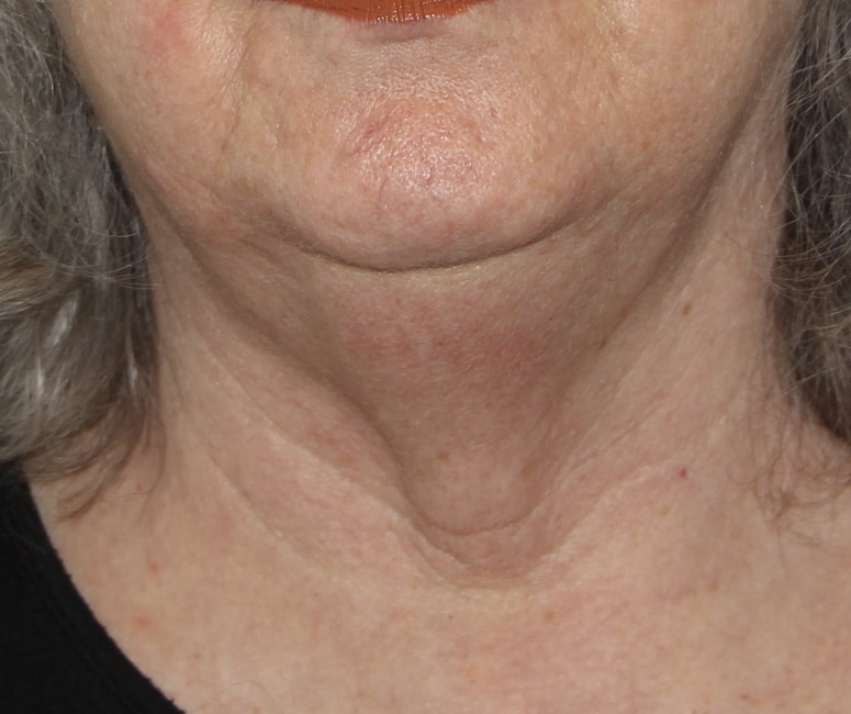 Before Image: Necklift - front