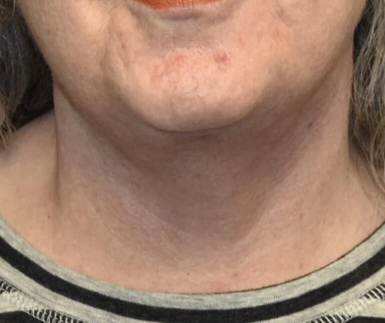 After Image: Necklift -