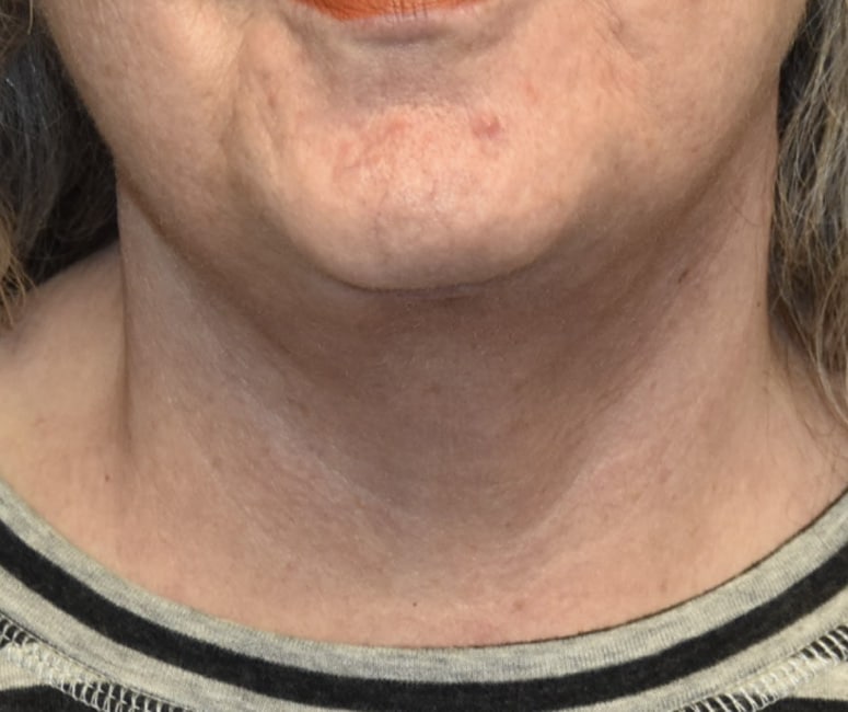 After Image: Necklift - front