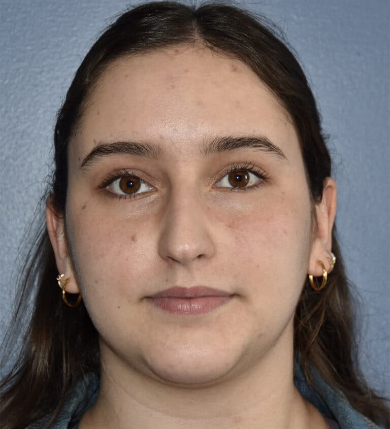 Before Image: Rhinoplasty - front