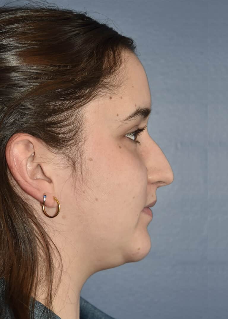 Before Image: Rhinoplasty - right-side