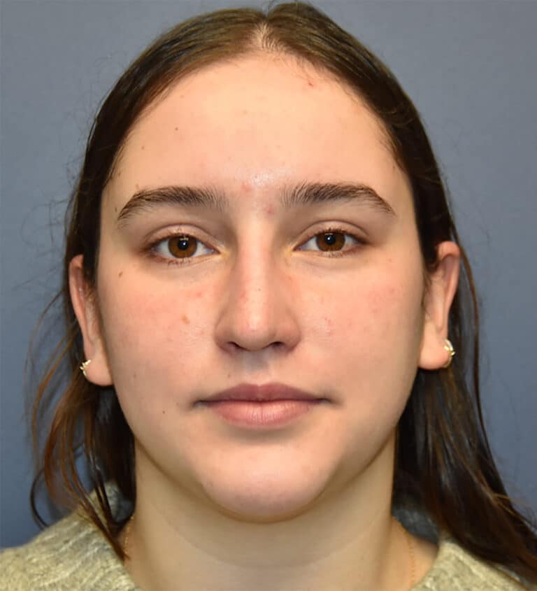 After Image: Rhinoplasty - front
