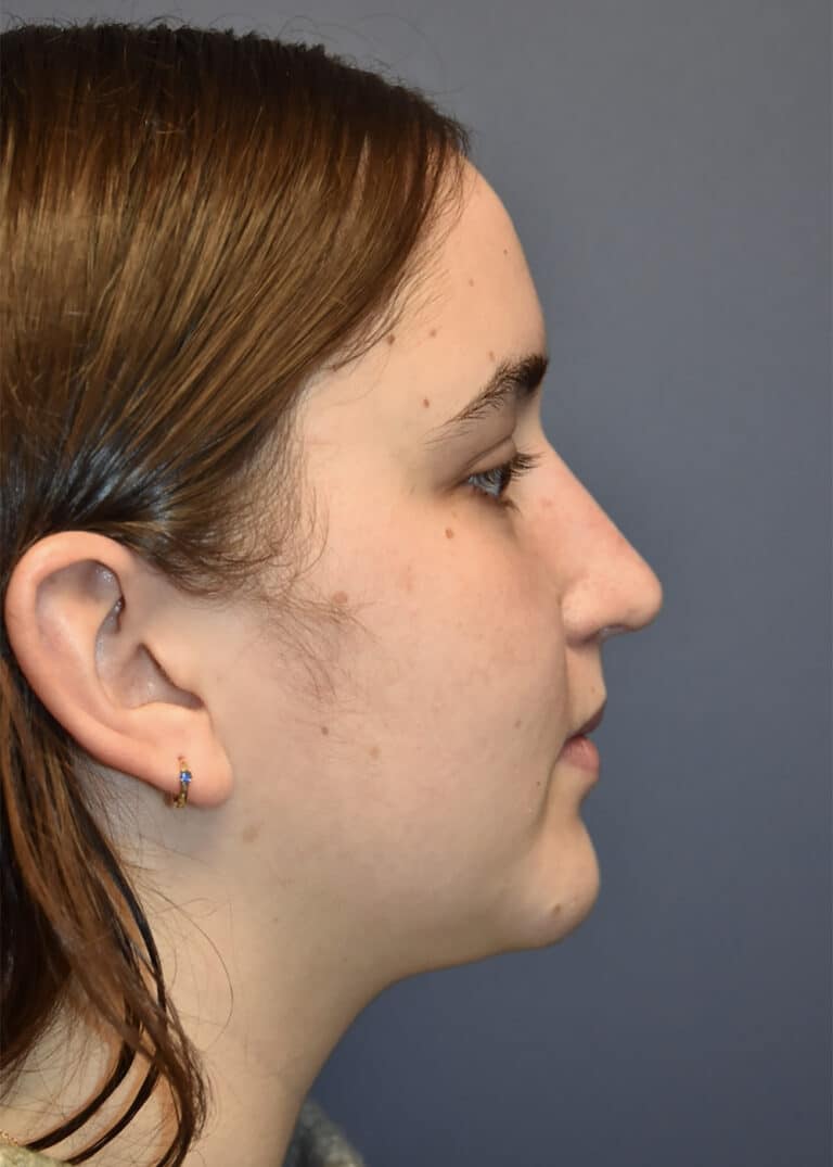 After Image: Rhinoplasty - right-side