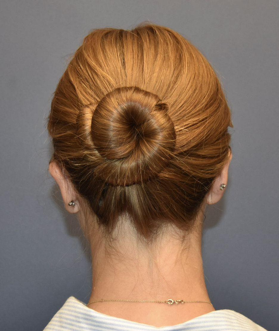 Postop back Preoperative back ear pinning after photo dr samuel lin