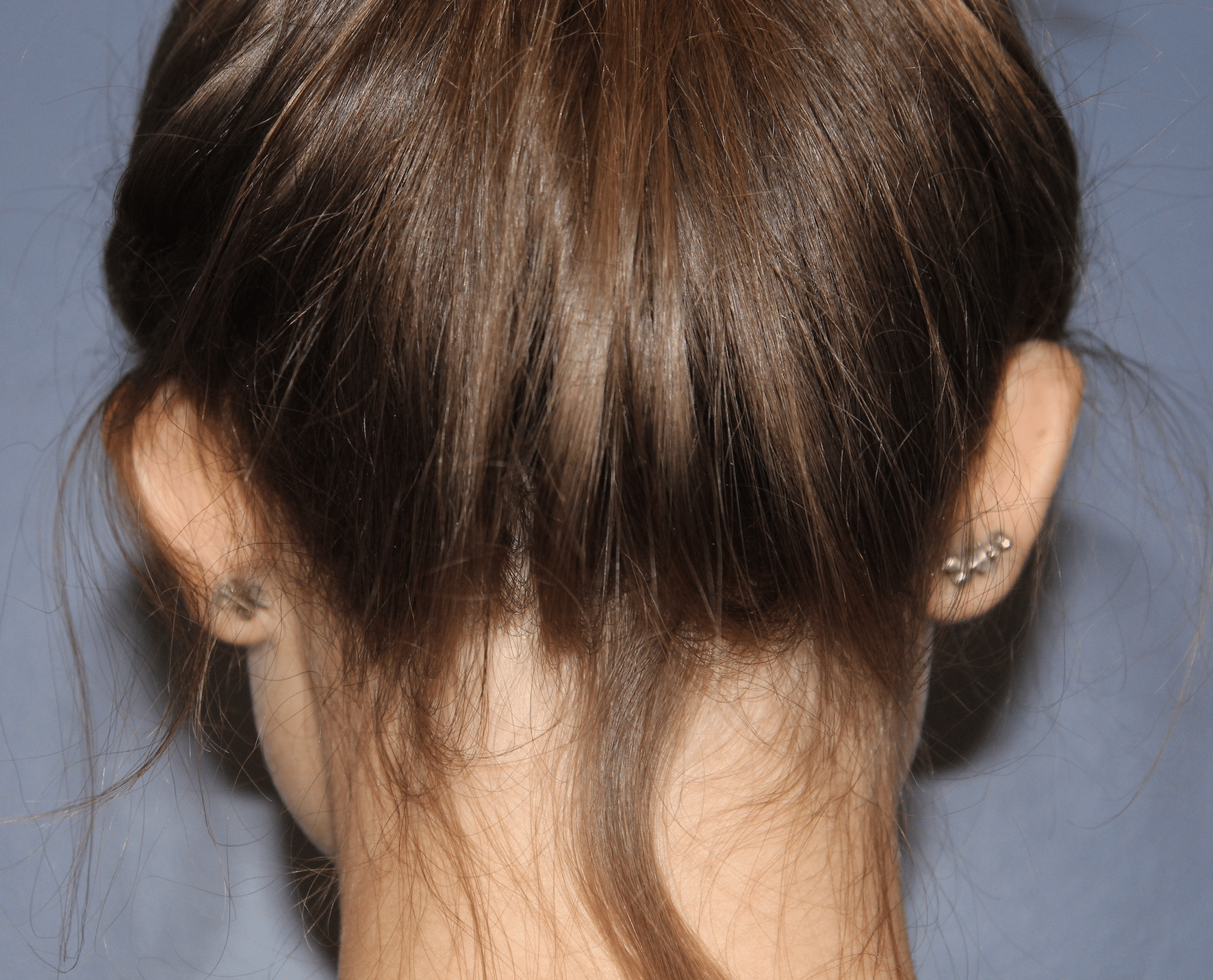 Preoperative back ear pinning before photo dr samuel lin