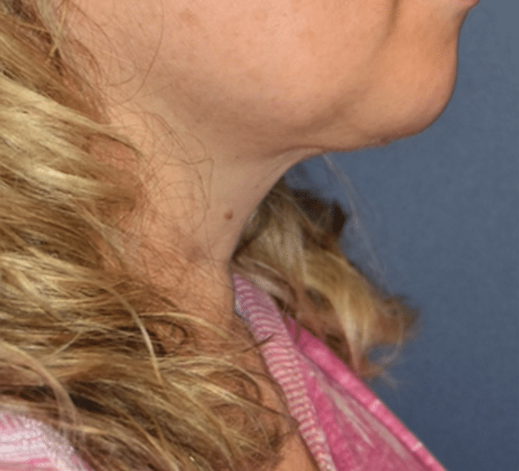 After Image: Necklift - right-side