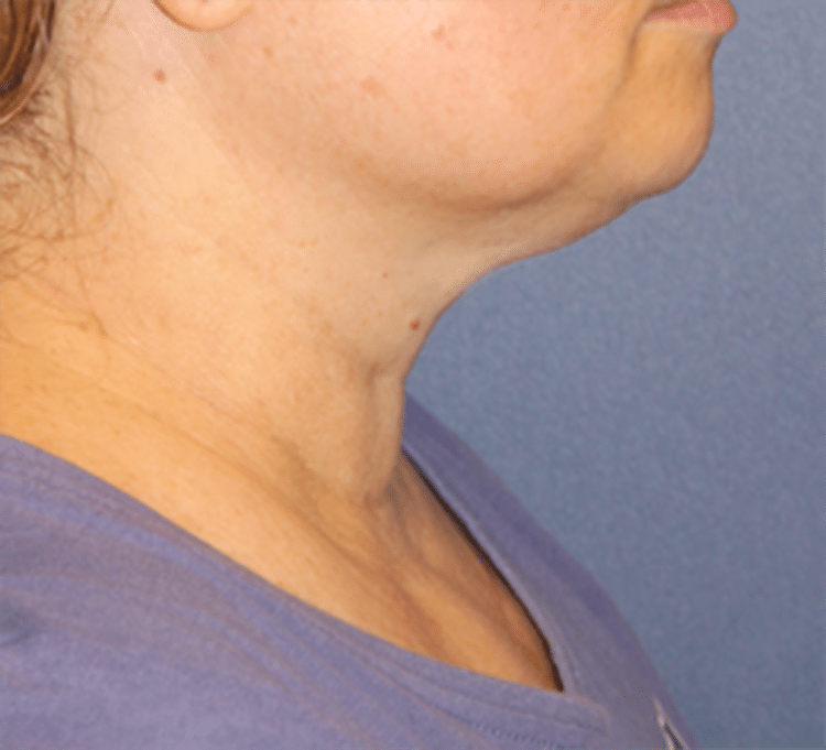 Before Image: Necklift - right-side