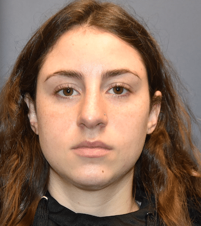 After Image: Rhinoplasty - front