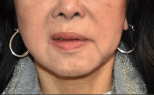 After Image: Necklift