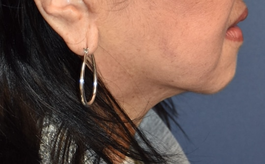 After Image: Necklift - right-side