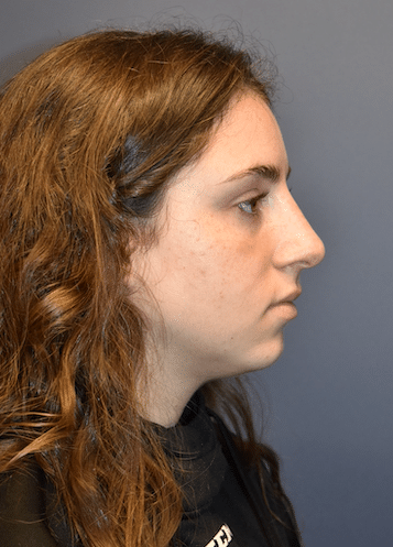 After Image: Rhinoplasty - right-side