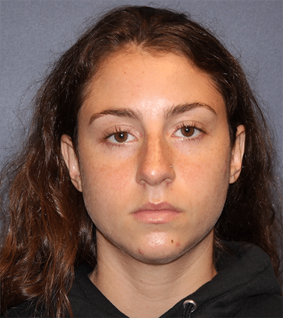 Before Image: Rhinoplasty - front