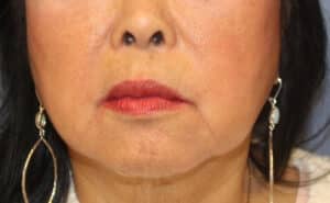 Before Image: Necklift