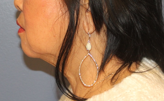 Before Image: Necklift - left-side