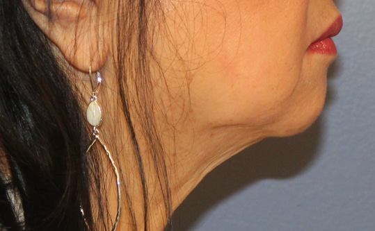 Before Image: Necklift - right-side