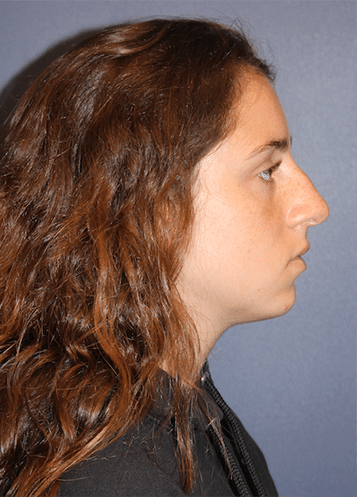Before Image: Rhinoplasty - right-side