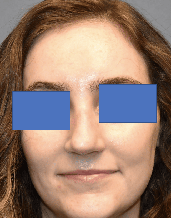 After Image: Rhinoplasty - front