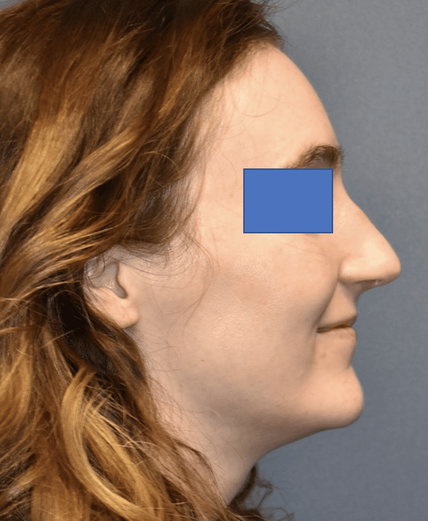 After Image: Rhinoplasty - right-side