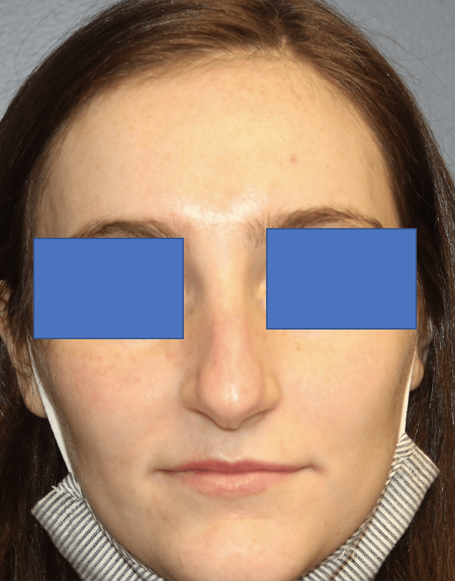 Before Image: Rhinoplasty - front