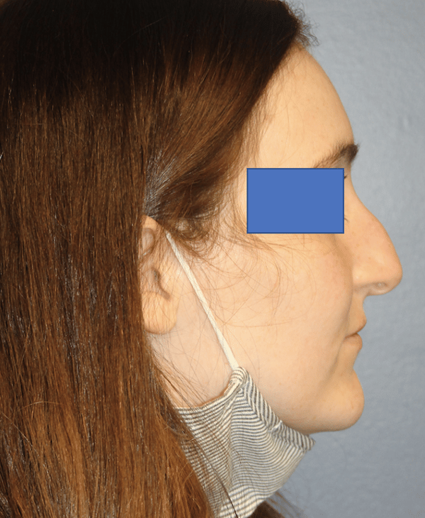 Before Image: Rhinoplasty - right-side