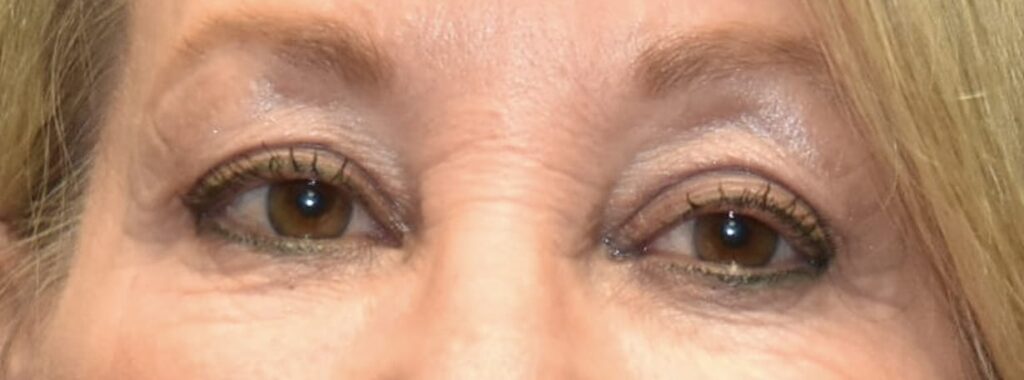After Image: Upper Eyelid Blepharoplasty - front