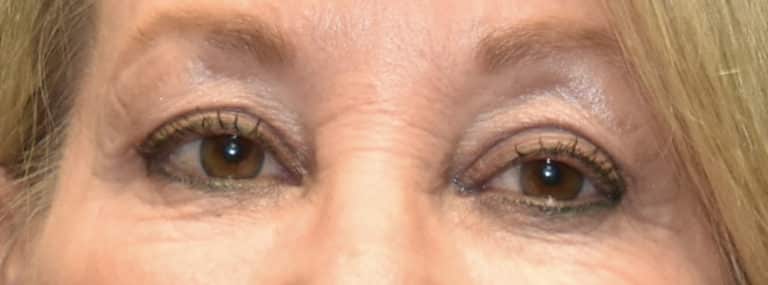 After Image: Upper Eyelid Blepharoplasty - front