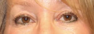Upper Eyelid Blepharoplasty