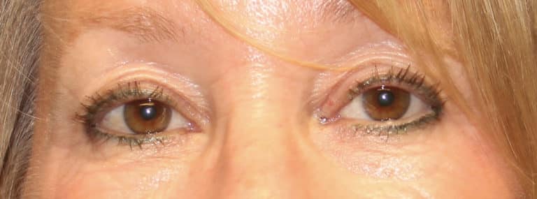 Before Image: Upper Eyelid Blepharoplasty - front