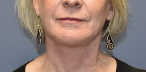 After Image: Necklift