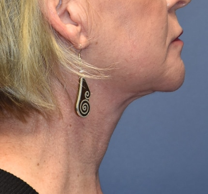 After Image: Necklift - right-side