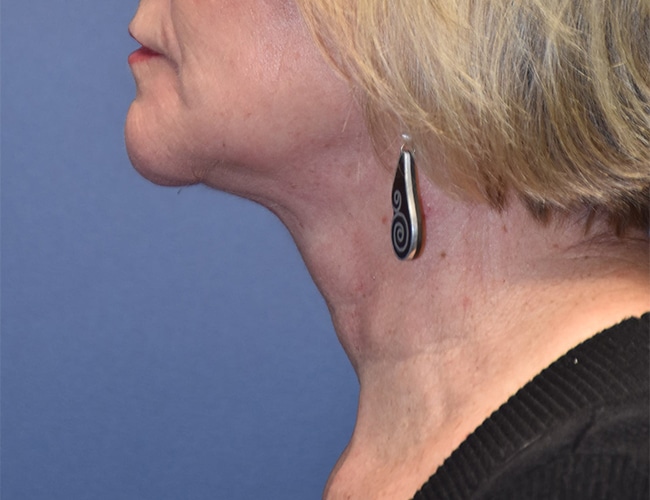 After Image: Necklift - left-side